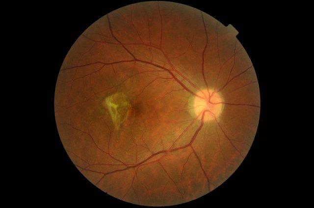 diagnostyka chorób siatkówki - fotografia dna oka