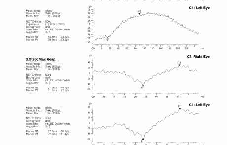gabinet okulistyczny - wyniki badań elektrofizjologicznych 1