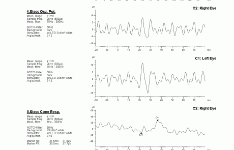 gabinet okulistyczny - wyniki badań elektrofizjologicznych 2