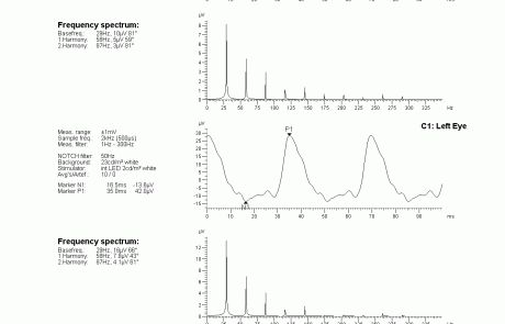 gabinet okulistyczny - wyniki badań elektrofizjologicznych 3