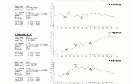 gabinet okulistyczny - wyniki badań elektrofizjologicznych 4