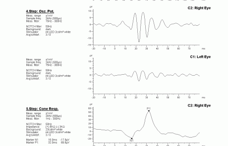 gabinet okulistyczny - wyniki badań elektrofizjologicznych 8